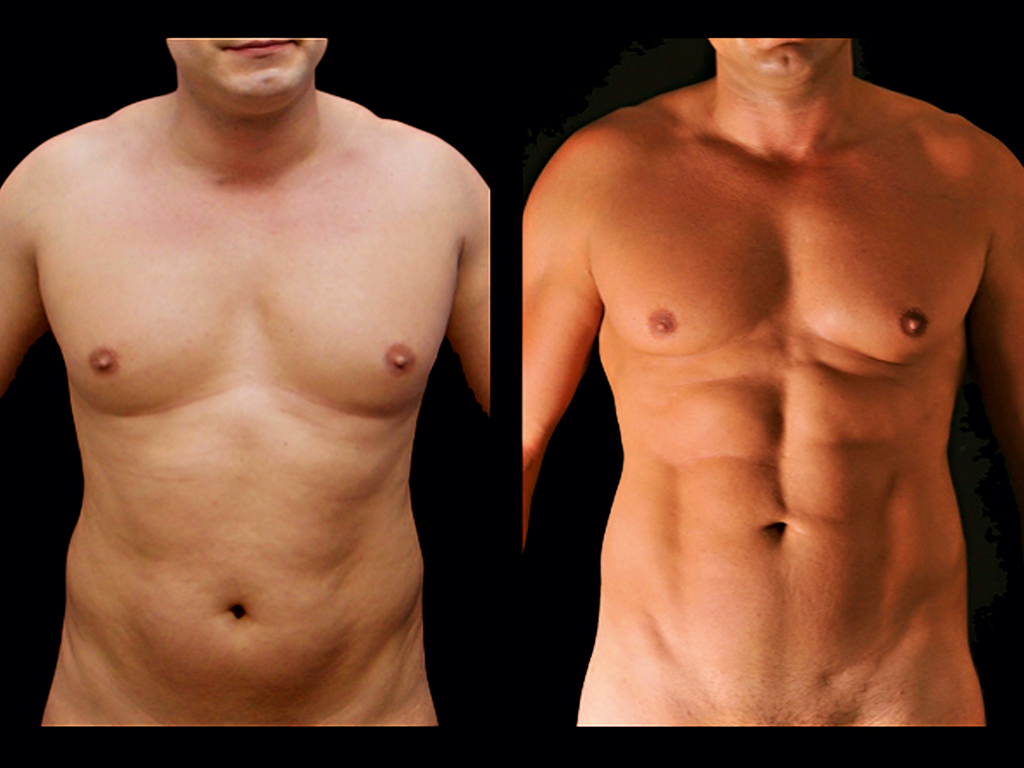 A patient before and after their liposculpture procedure
