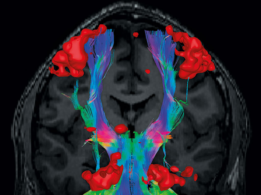 An image showing the activated areas of the brain responsible for finger movement (in red) and the white matter tracts connecting these areas to the rest of the brain